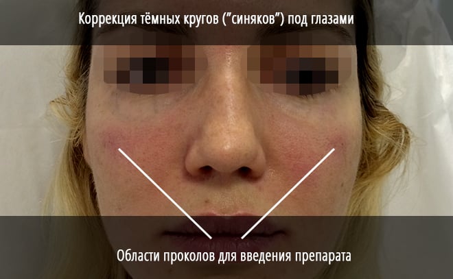 Гиалуроновая кислота для лица от морщин - эффект, помогает ли гиалуронка против морщин