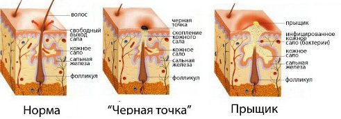 Схема образования прыщей и чёрных точек