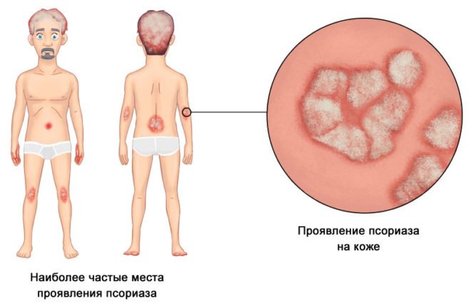 Псориаз Псориаз