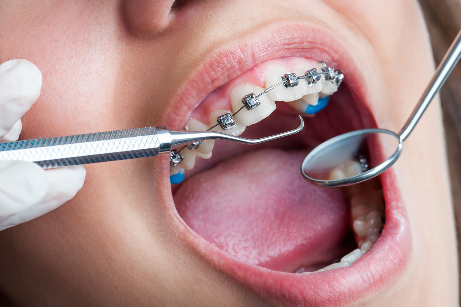 Ортодонтия: основные особенности, аспекты, методы лечения