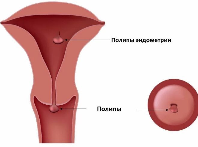 Что такое полип эндометрия и его влияние