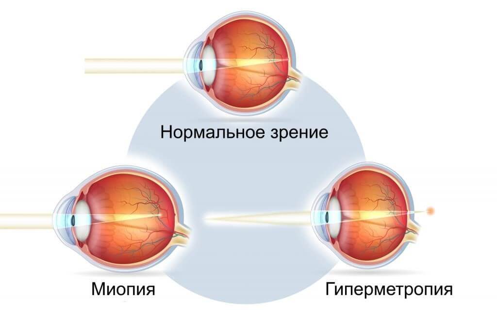 Кому и в каких случаях делают лазерную коррекцию миопии